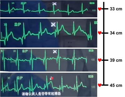 Case Report: Persistent left superior vena cava: an incidental finding during peripherally inserted central catheter placement